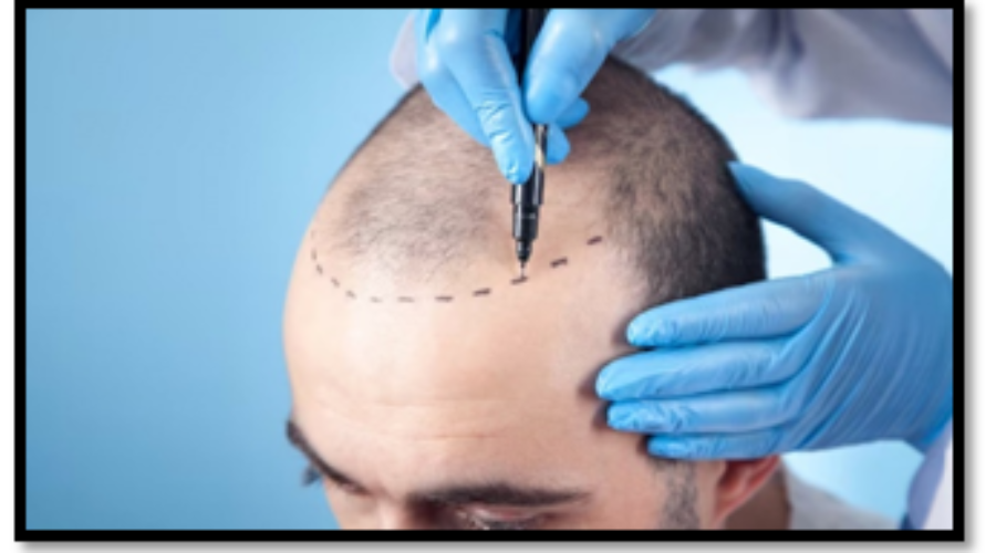 Vikas Hair Transplantation Clinic